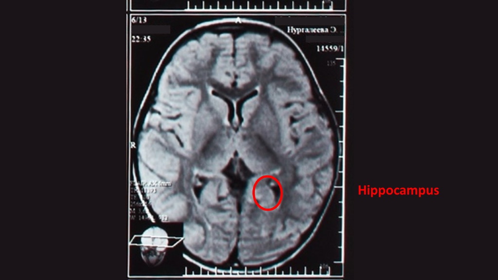 Hippocampus Region im Gehirn